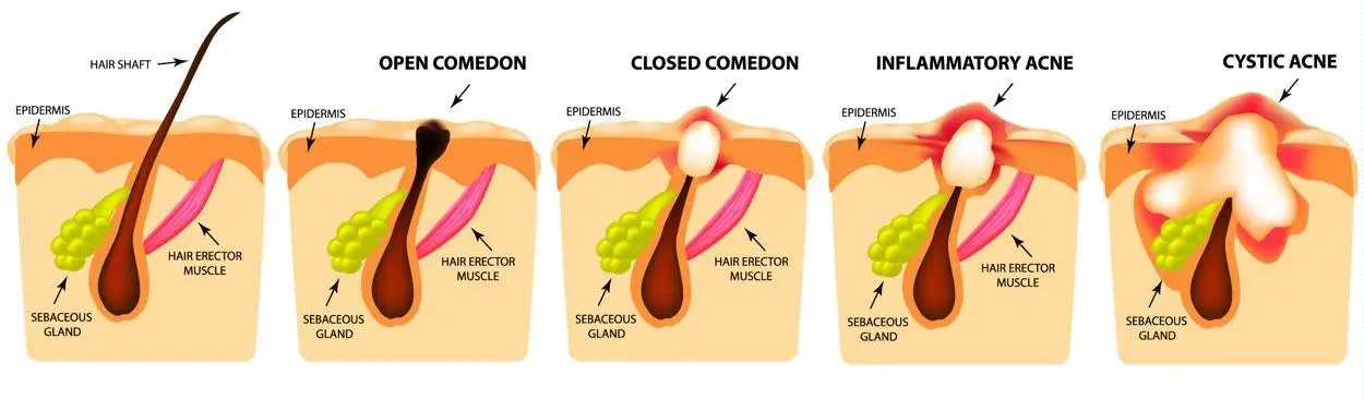 acne - cbd and skin disorders